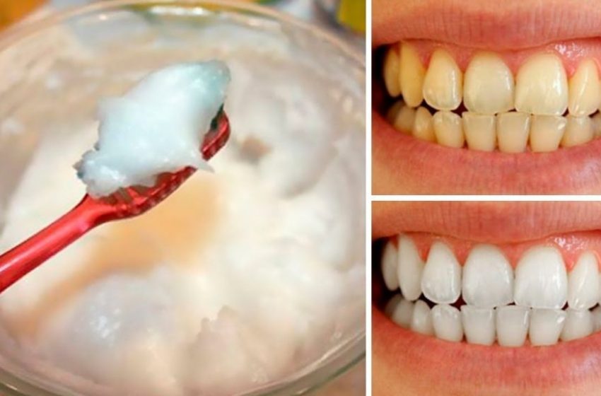  How to Whiten Your Teeth Naturally